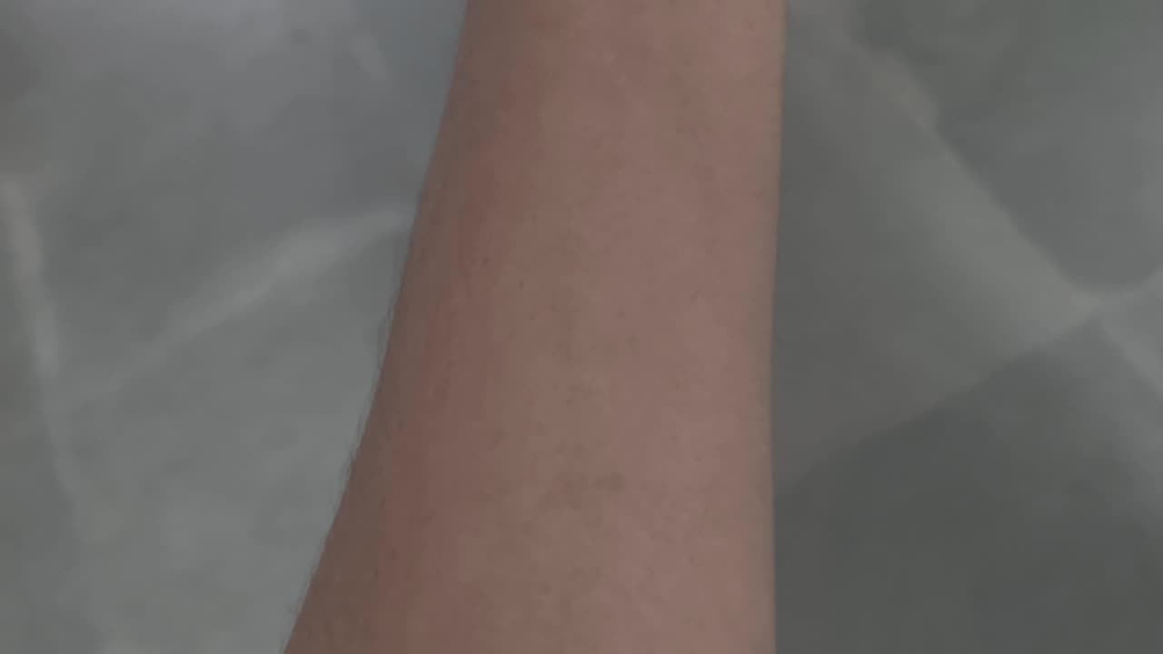 Uritcaria #Hives# burns