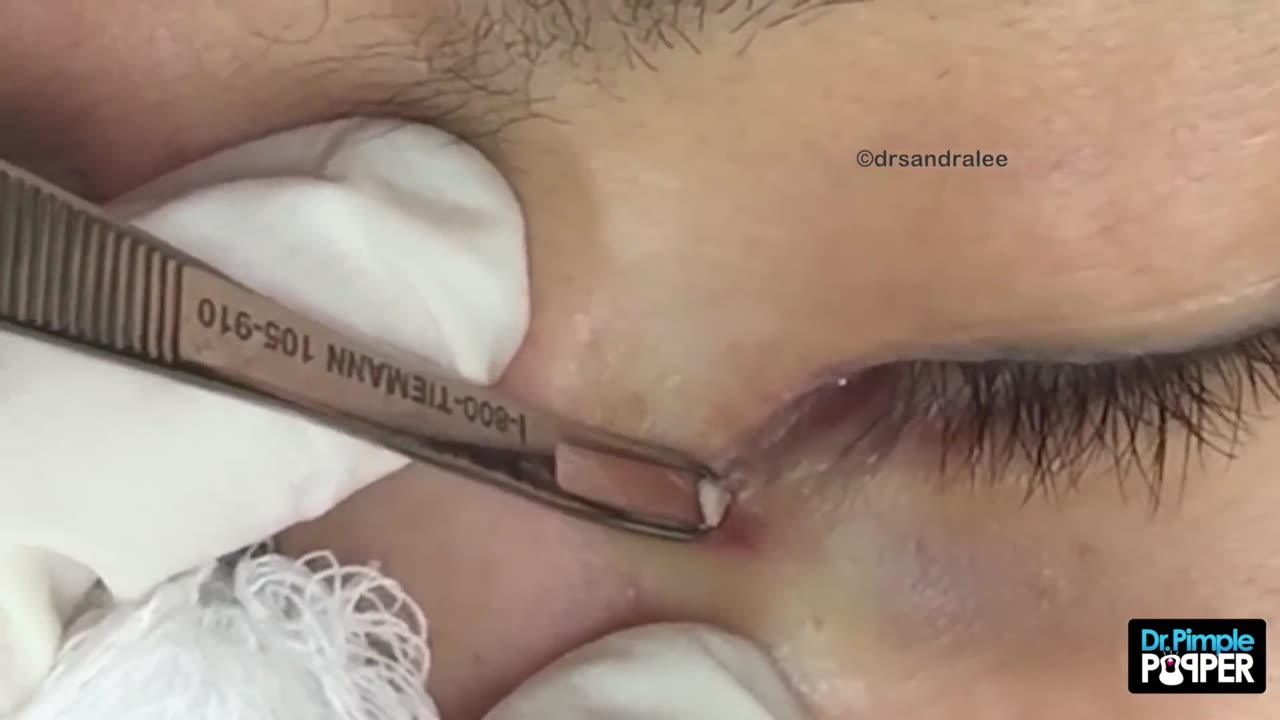 Milium Extraction from a Very Delicate Inner Eye Area