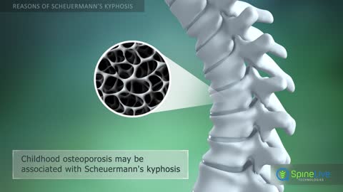 Scheuermann’s