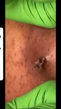 Pimple Popping Acne Treatment Blackhead Extraction