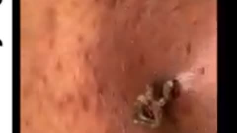 Pimple Popping Acne Treatment Blackhead Extraction