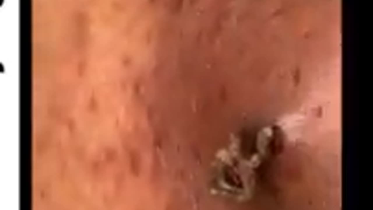 Pimple Popping Acne Treatment Blackhead Extraction