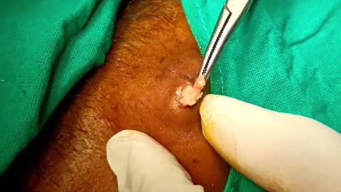 Pilar cyst on scalp