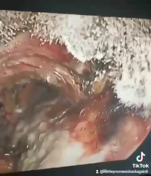 Covid-19 "Vaccine" - Effects On The Inside Of You're Lungs! - HYDRA OXIDE #WAKEUP FAST PEOPLE!