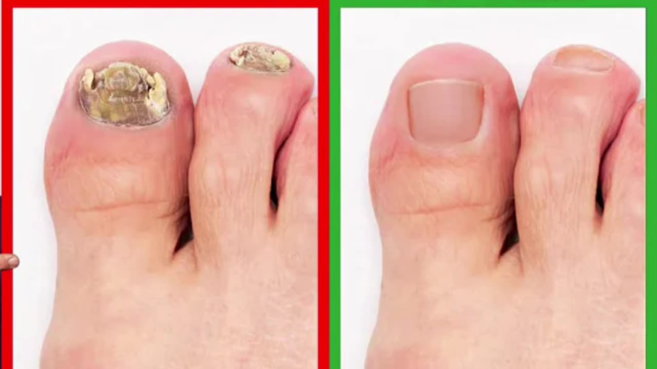 TOENAIL FUNGUS ~ BEST TREATMENTS