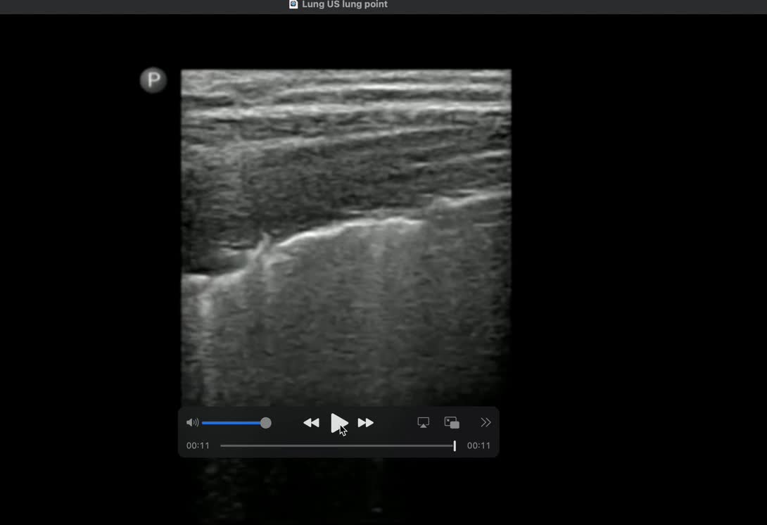 Ultrasound pneumothorax