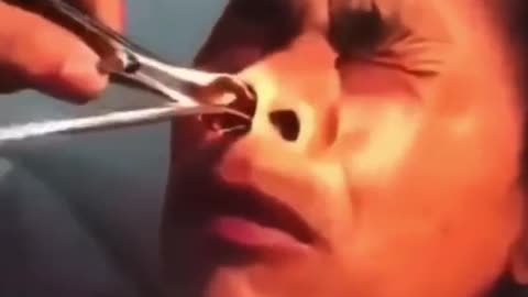 Watch What Comes Out of Chinese Man's Nose