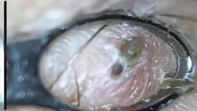 How to remove blackheads from nose, pop pimples, acne treatment #54 #shorts