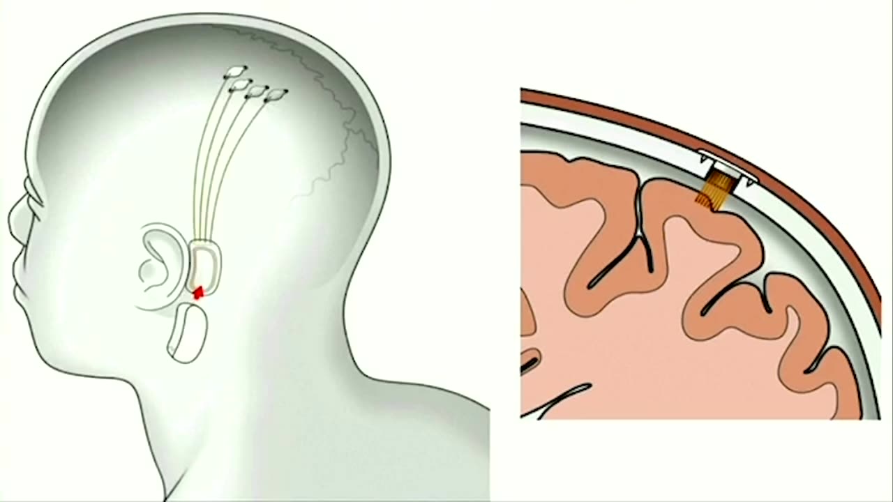 If a brain implant could treat your depression, would you accept it?