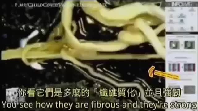 打過疫苗的屍體,血液裡有蛋白質凝結的血栓