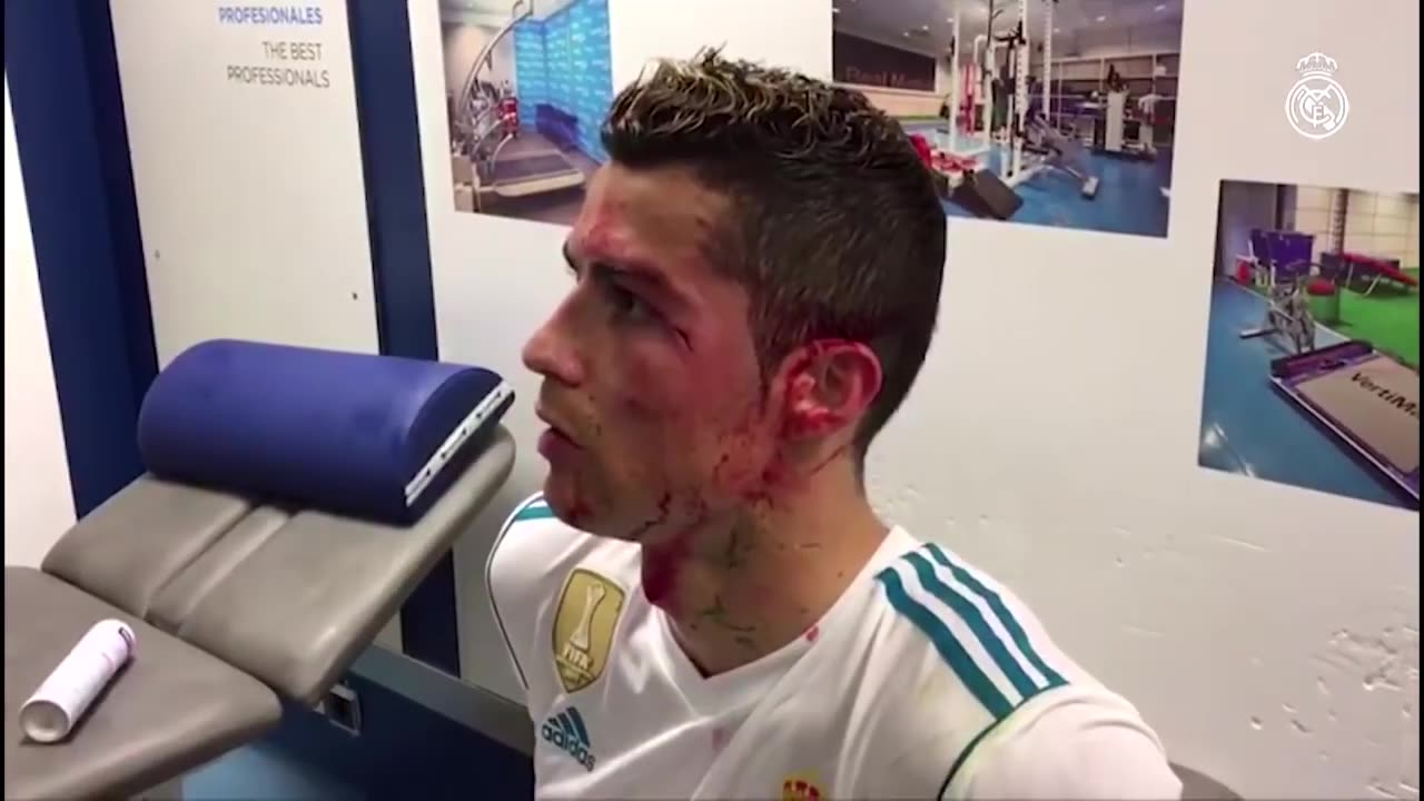 Cristiano Ronaldo INJURY | BLOOD ALL OVER FACE 😟