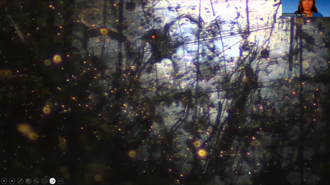 Dr Ana Maria Mihalcea - Darkfield Microscopy of Lantus Insulin Shows Self Assembly Hydrogel