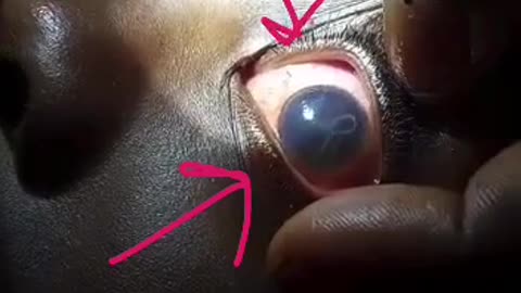 Parasites Found in the Eyes of the Vaxxed ~