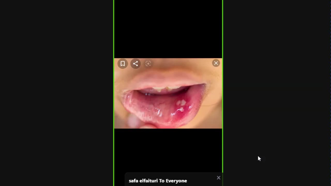 ST5.Mr Edward 25 years with oral ulcer