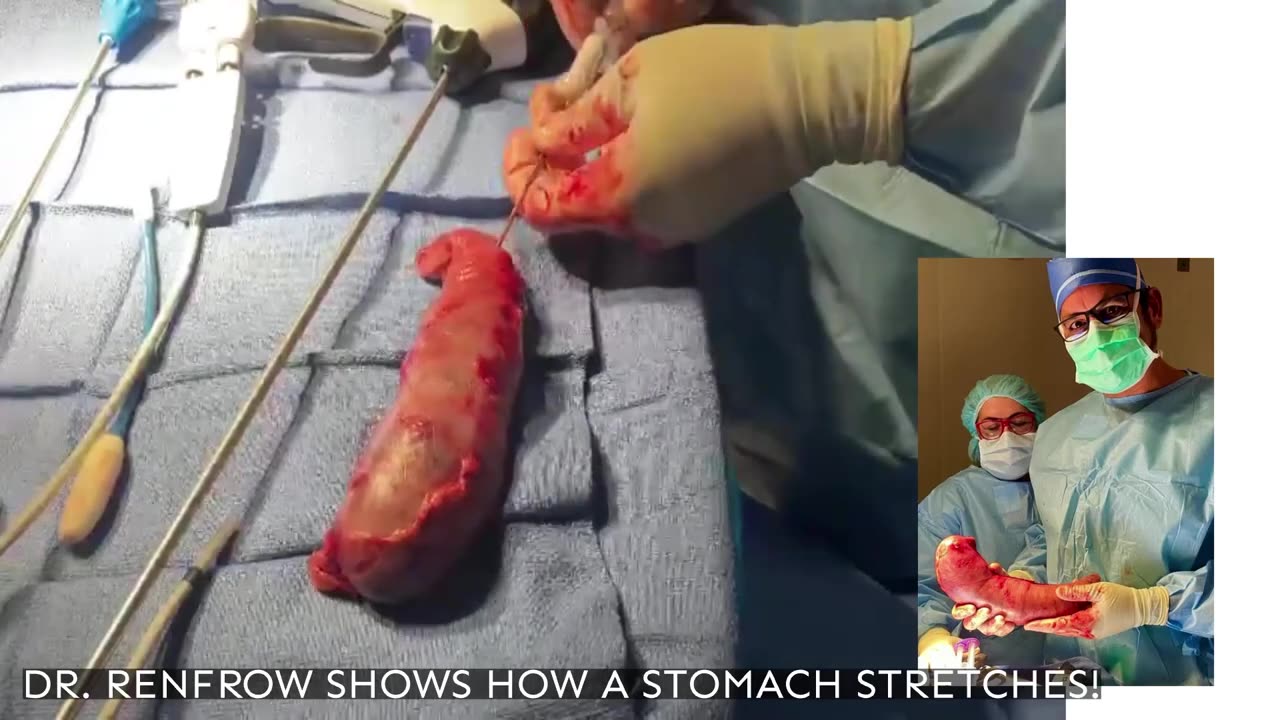 Stomach Stretching: Watch Dr. Renfrow's Incredible Demonstration