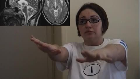 Video 7.3 Holmes tremor