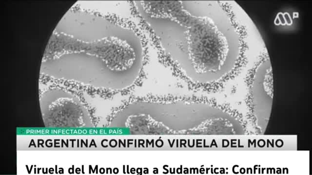 Viruela del Mono llega a Sudamérica: Confirman caso en Argentina