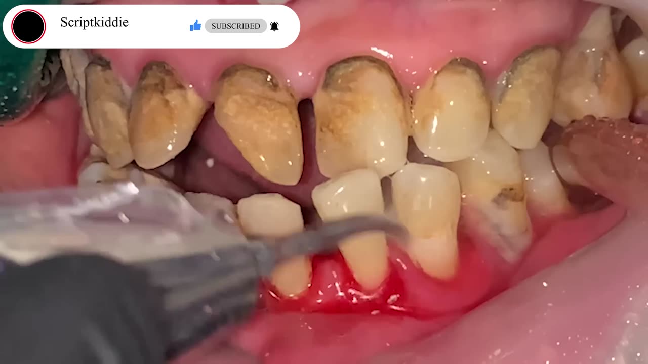 Female's Teeth | Full Of Tartar | Scalling tartar