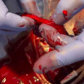 Surgeon on a 40 year old Vaccinated Athlete... graphene, myocarditis