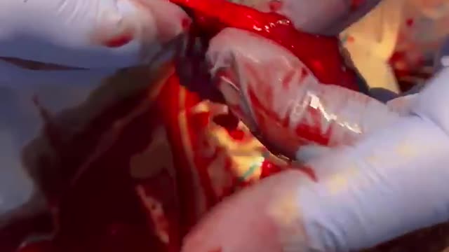 Surgeon on a 40 year old Vaccinated Athlete... graphene, myocarditis