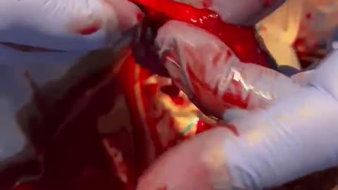 Surgeon on a 40 year old Vaccinated Athlete... graphene, myocarditis