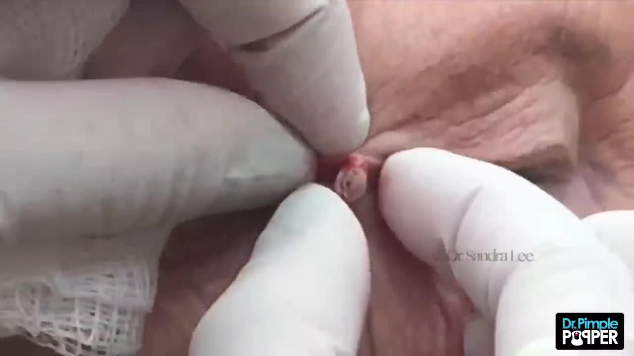 A big blackhead I can't believe I didn't see sooner! (THROWBACK THURSDAY)