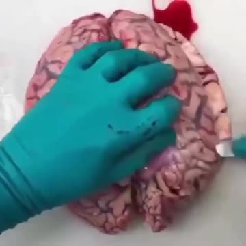 Autopsy Of Blood Clot In The Brain Of Vaccinated Person
