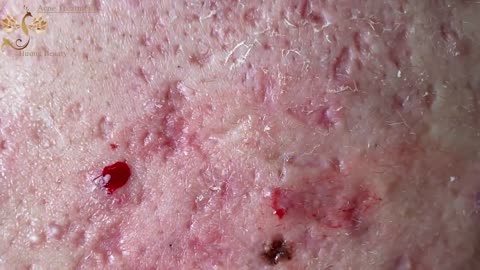 #115 | Acne Treatment Huong Beauty