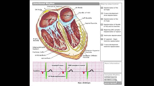 Dr Stanley's ECGcourse.com | Junctional Rhythm Tutorial