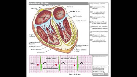 Dr Stanley's ECGcourse.com | Junctional Rhythm Tutorial