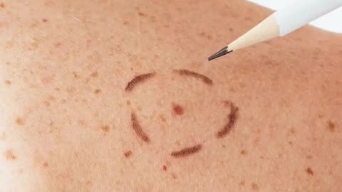 Interesting FACT about MOLES on the body! / Informative & Interesting #informative #interesting