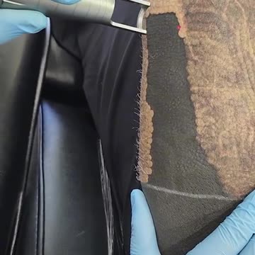 Blackout Tattoo Removed with Lasers!