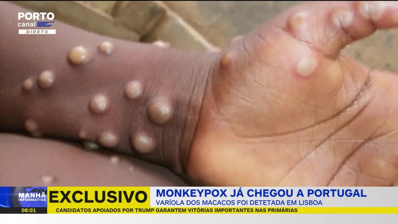 Virus Monkey Pox? O que é isto?