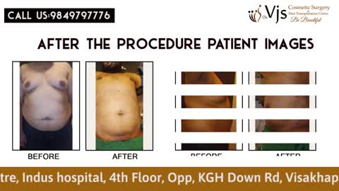 Procedure of Liposuction Surgery Vizag - Dr. NSS Anusha & Dr. C.Vijay Kumar