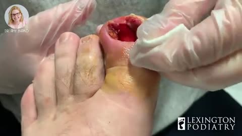 Toenail ingrown