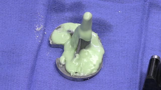 Total knee replacement