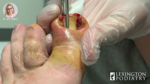 WE'RE THANKFUL FOR THIS EPIC INGROWN