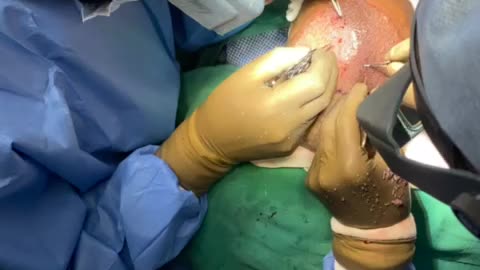 Hair transplant