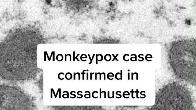 Monkeypox case confirmed in Massachusetts