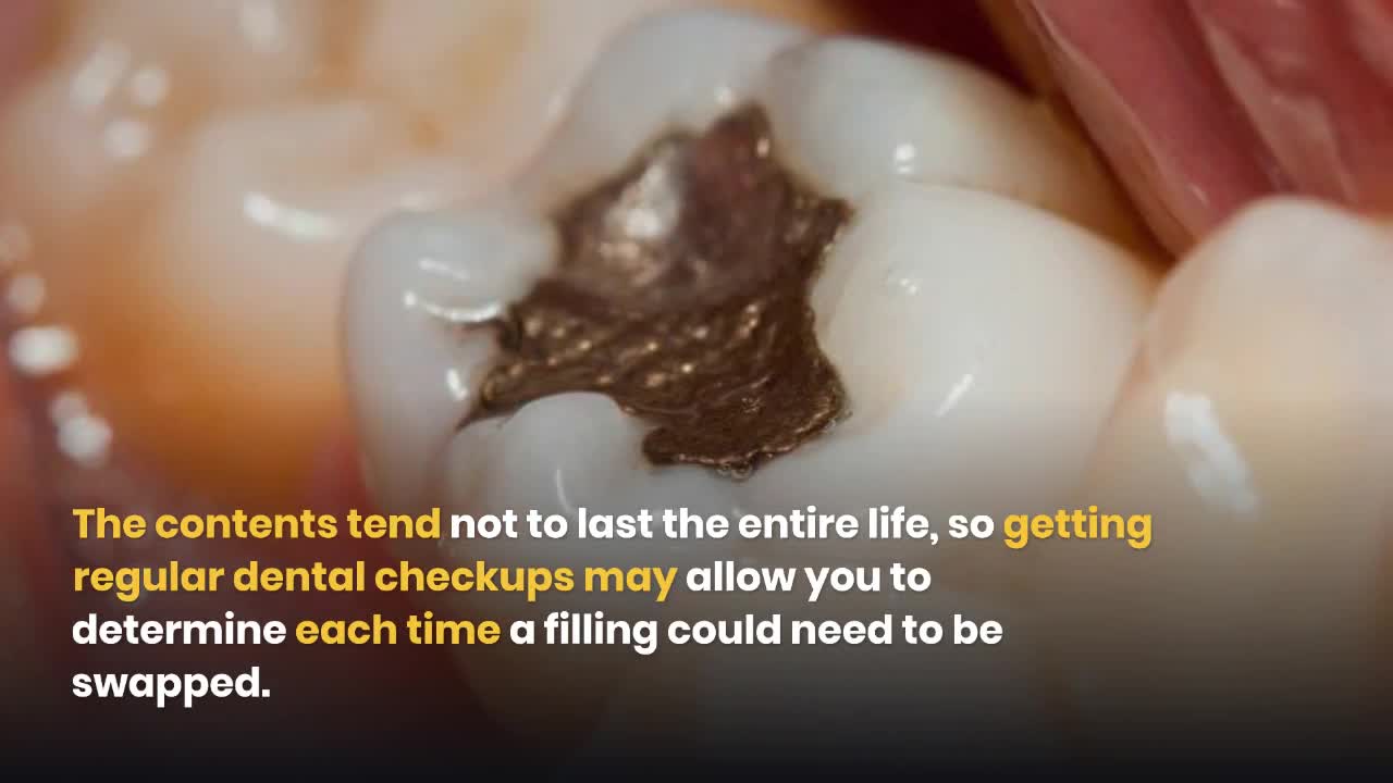 How Long Do Dental Fillings Last