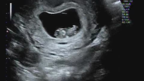 Baby ultrasound image and sound (1)