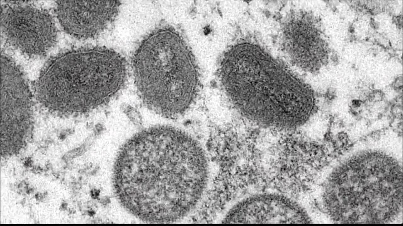 World Health Organization looking for new name for monkeypox