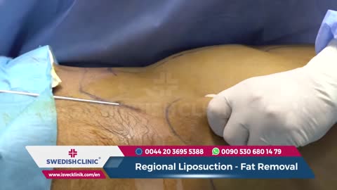 Liposuction Surgery Full Concept Video || How Fats Are Removed From Our Body