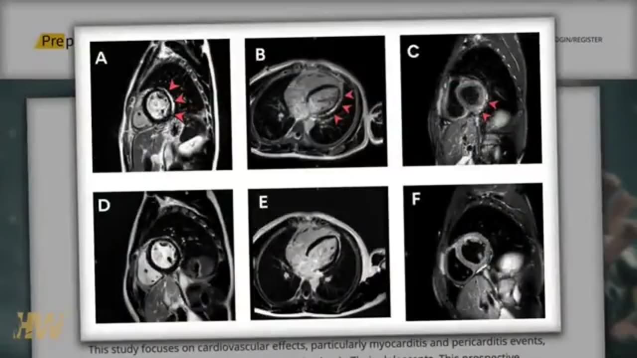 2.3/2.8% rate of myocarditis in adolescents/health care workers after Covid vaccine.