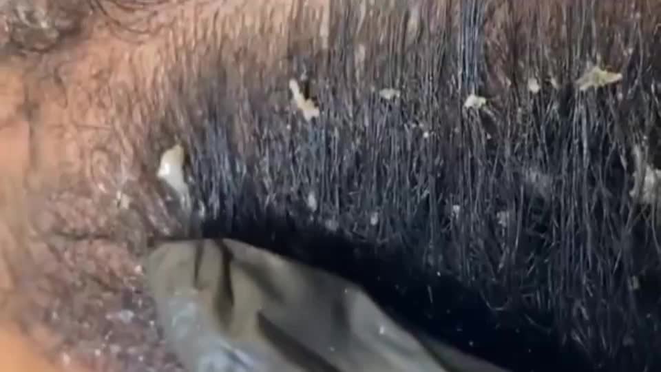 Dandruff Removal