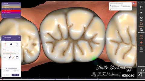 #design #naildesign #dental #dentaldesign #exocadexpert