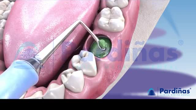 DRY SOCKET , Infection After Tooth extraction: caused and treatment ***