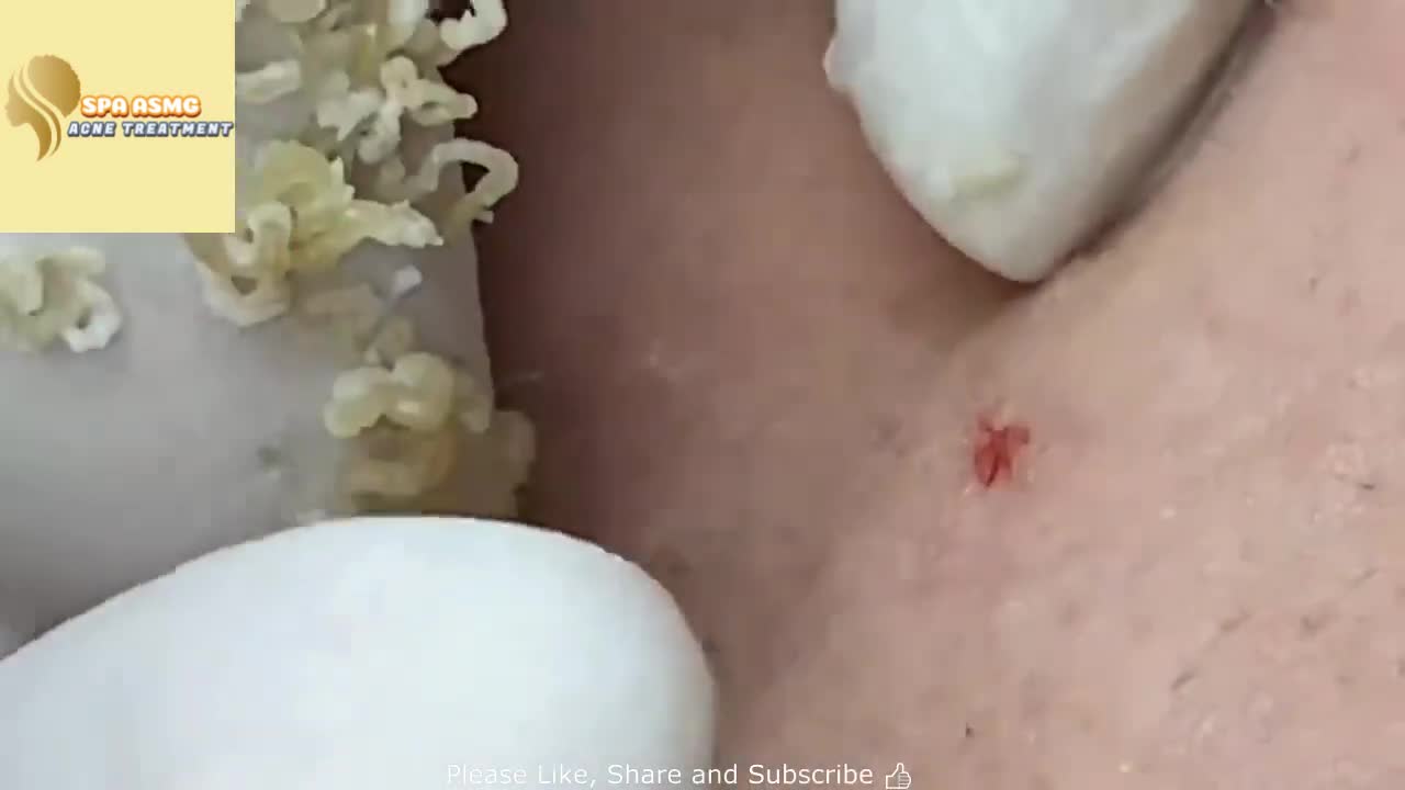 BIG Blackheads Removal