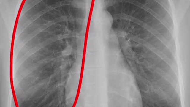 How to : read a Chest X-ray in 1 Minute