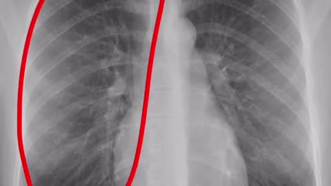 How to : read a Chest X-ray in 1 Minute